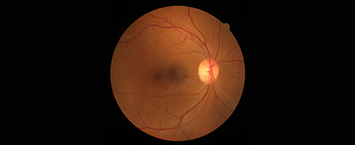 retinal